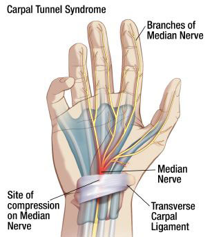 Carpal Tunnel Syndrome diagram