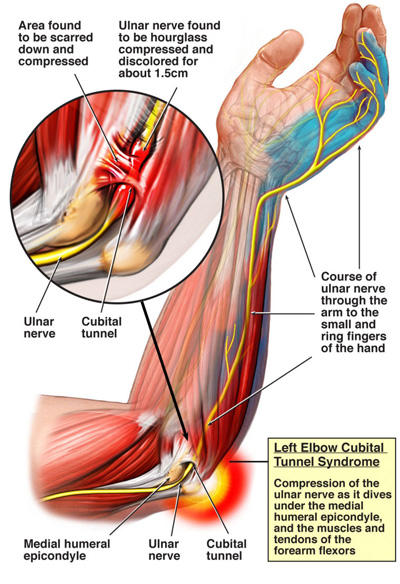 Cubital Tunnel Syndrome diagram