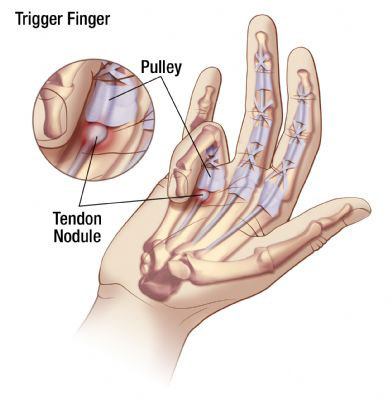 Trigger Finger diagram
